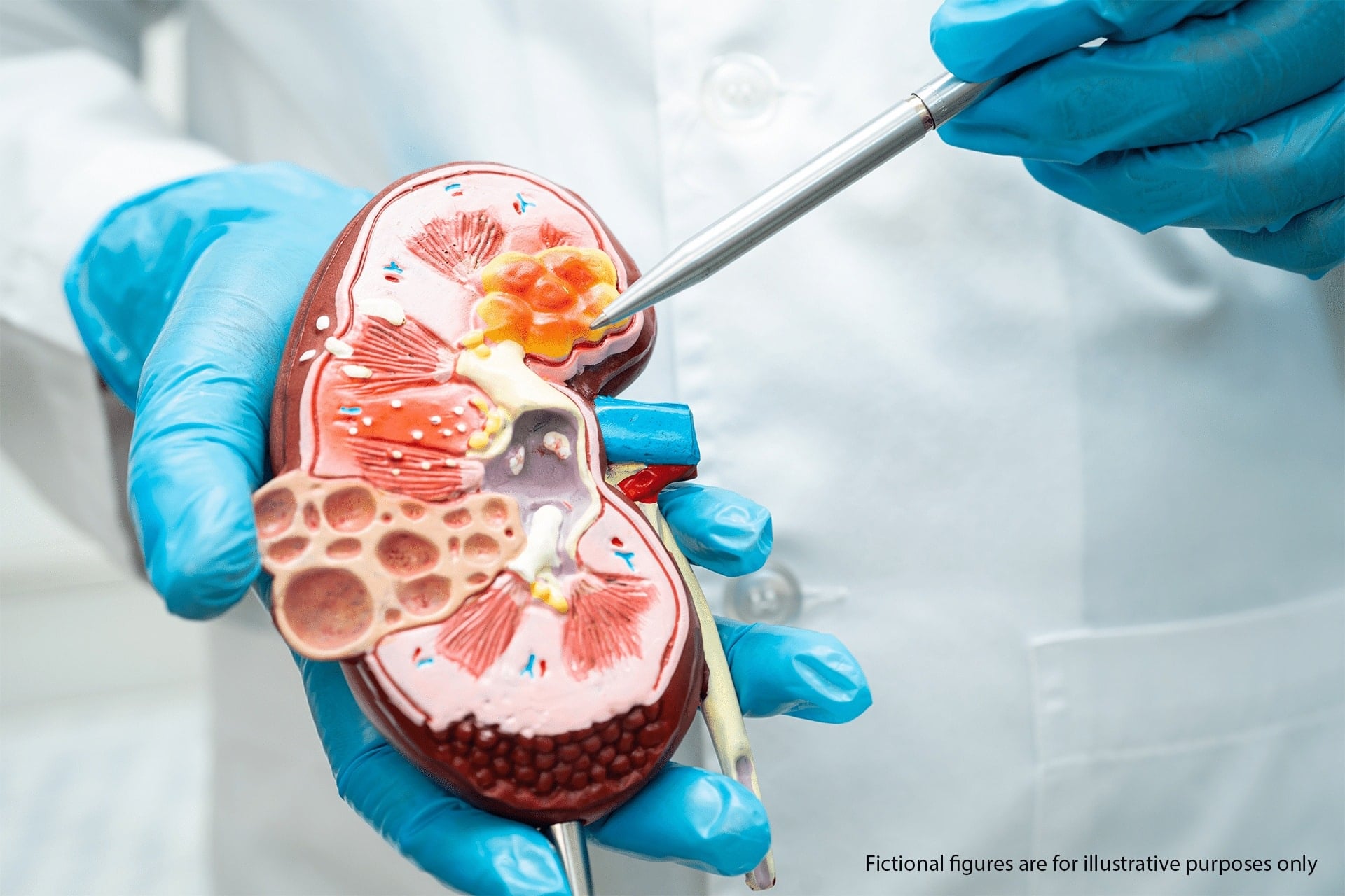 kidney-disease-warning-signs-50-plus